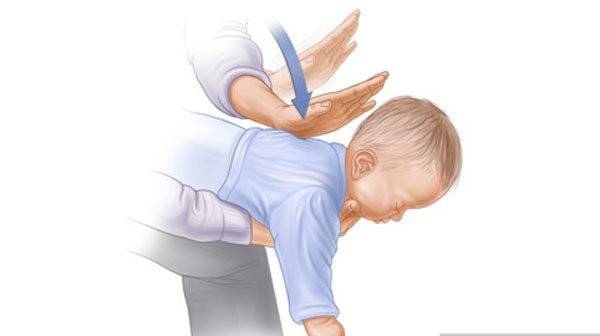 婴儿气道异物急救手法.jpeg