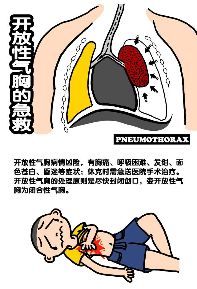 开放性气胸的现场急救.jpg