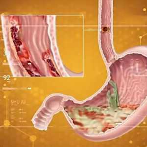 说说那些由细菌、病毒引起的癌症