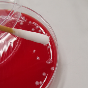 高毒力肺炎克雷伯菌致脑脓肿一例